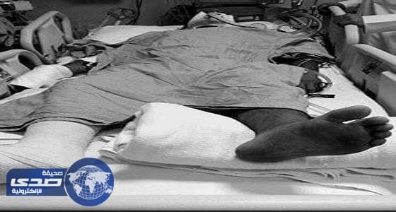 سخرية واسعة من وضع جبيرة على القدم السليمة لمريض و ترك المصابة