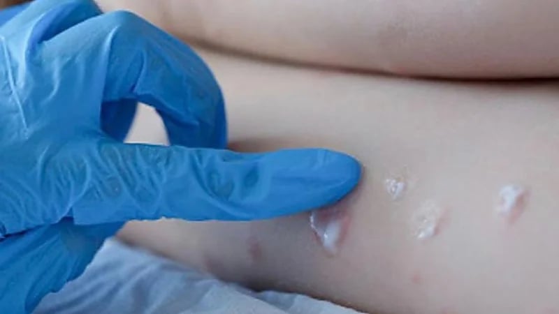 أمريكي مصاب بجدري القرود يهرب من مستشفى في المكسيك لخارج البلاد