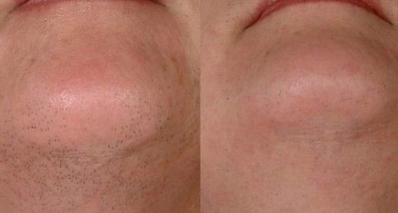 وصفة روسية بمكونان فقط  للتخلص من شعر الوجه الزائد