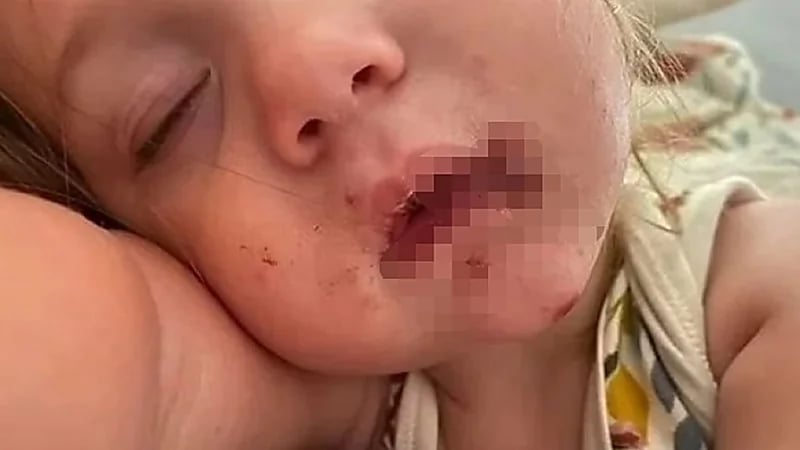 شاهد.. طفلة تتعرض لفيروس خطير بسبب قبلة