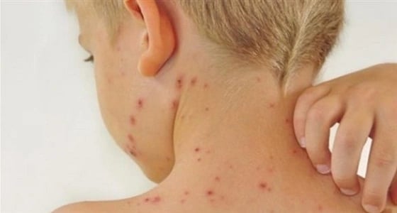 التوعية الصحية بألمانيا: أعراض الجرب تظهر بعد أسبوعين من الإصابة