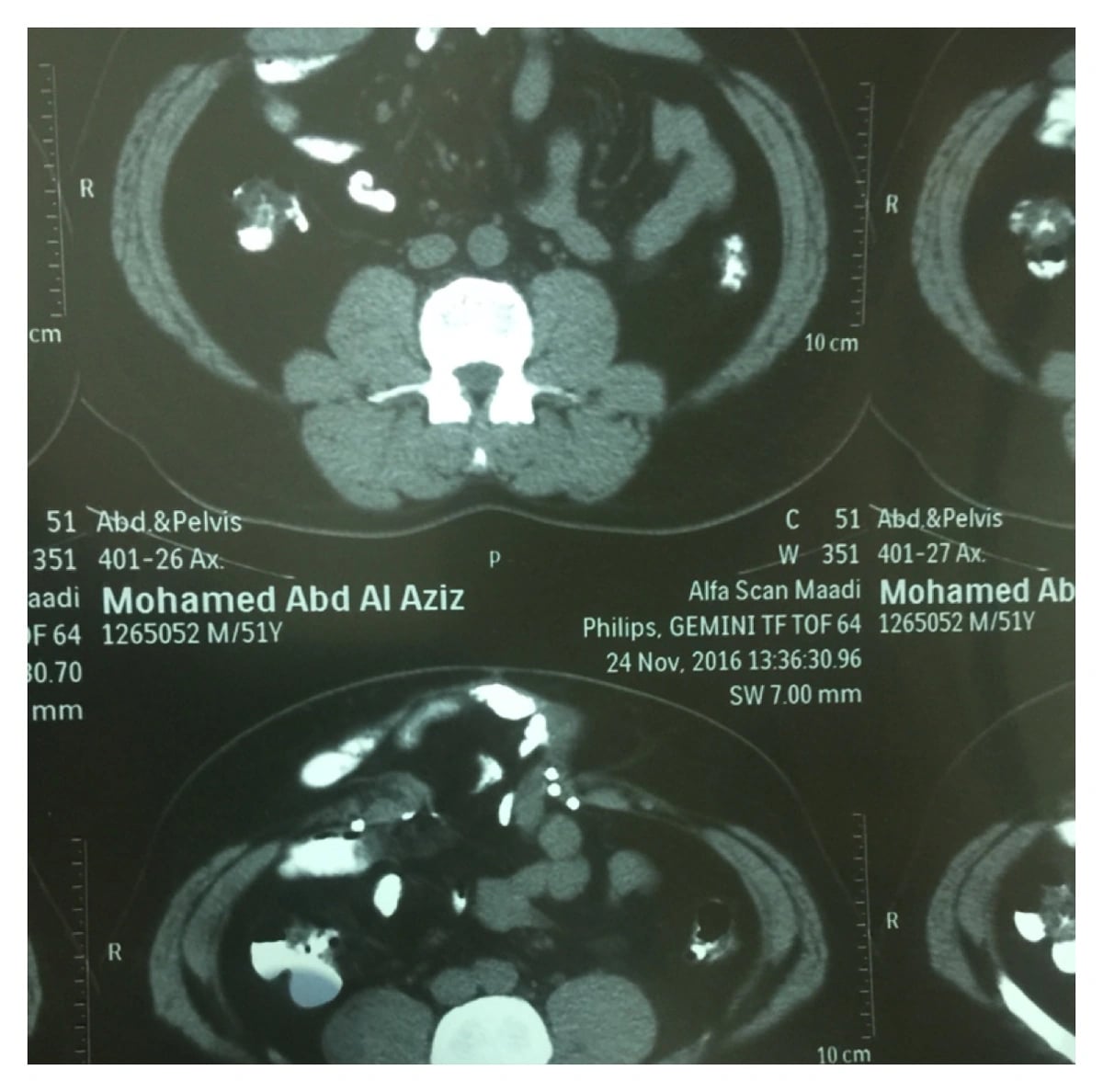 فريق طبي ينجح في اجراء عملية جراحية معقدة في مستشفى الفيصل