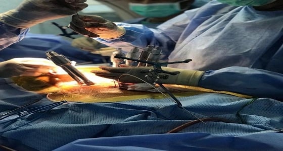 نجاح عملية تثبيت كسر بالفقرة القطنية الأولى في مجمع الدمام الطبي