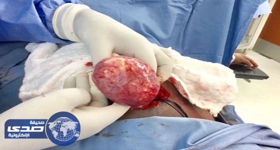 فريق طبي ينجح في استئصال ورم بالرحم لطبيبة بمستشفى السليل