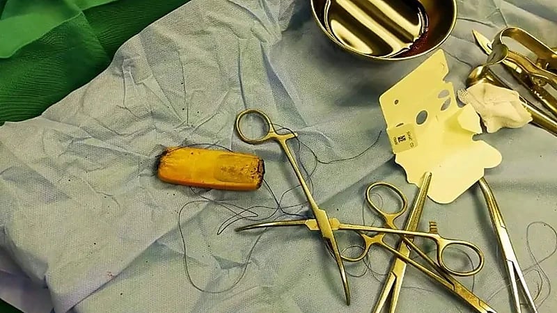 فريق طبي يتفاجأ بشيء غريب في معدة مريض