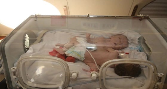 بالفيديو والصور.. نقل التوأم السيامي الفلسطيني حنين وفرح إلى المملكة لإجراء عملية الفصل 