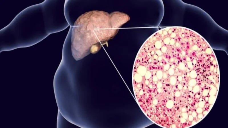 الخضيري: ترك الخبز والمخبوزات يقلل الدهون حول الكبد