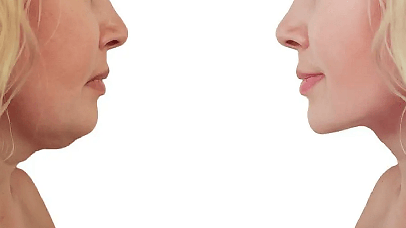 طرق بسيطة للتخلص من دهون الرقبة