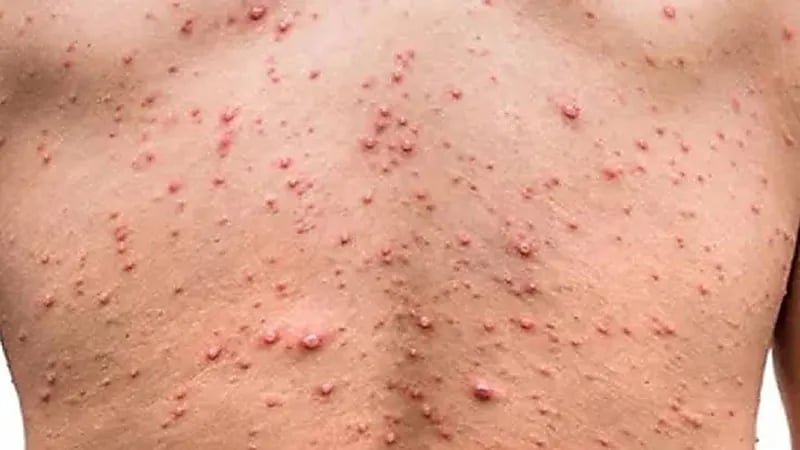 أمريكا تطالب المثليين والمثليات بالتسجيل للحصول على لقاحات جدري القرود