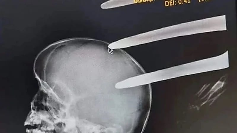 مصرع طفل بـ شوكة في الرأس أثناء لعبه