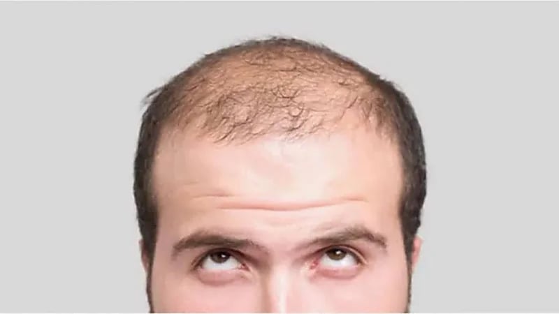 اكتشاف علاج طبيعي لتساقط الشعر دون الحاجة إلى الزراعة