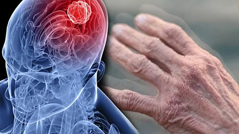 علماء بريطانيون يطورون اختبارًا يتنبأ بباركنسون عبر الجلد