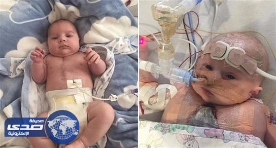 طفل بنصف قلب يُخالف توقعات الأطباء وينجو من الموت