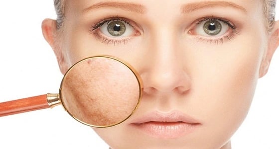 وصفة سحرية للتخلّص من الكلف