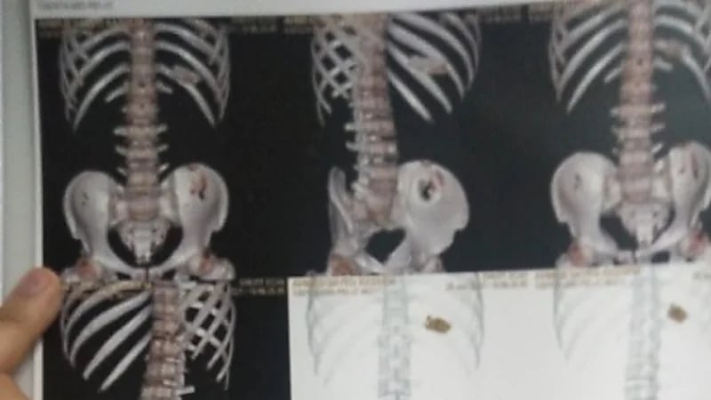 شاب يبتلع هاتفه المحمول 3 أشهر