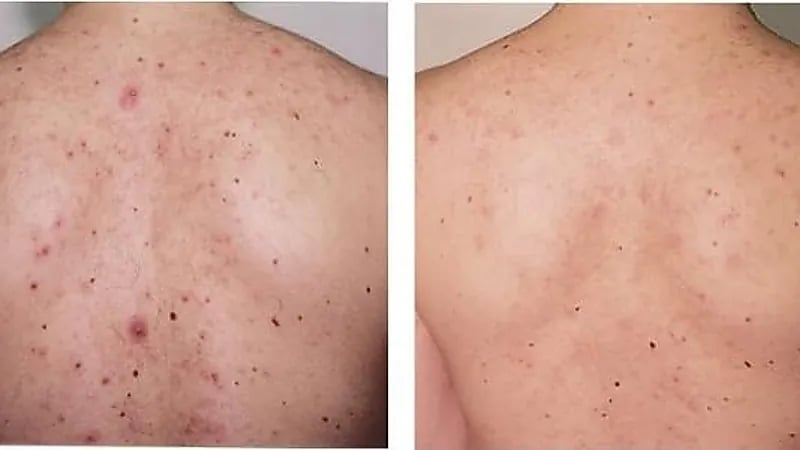 بالفيديو.. طبيب يوضح علاقة بعض الأطعمة بزيادة حبوب الظهر