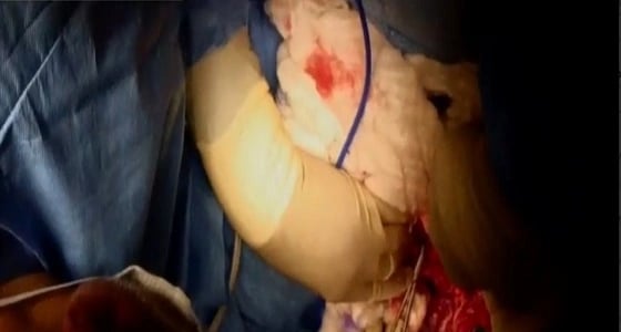 الصور الأولى لعملية فصل التوأم السيامي " فرح وحنين "