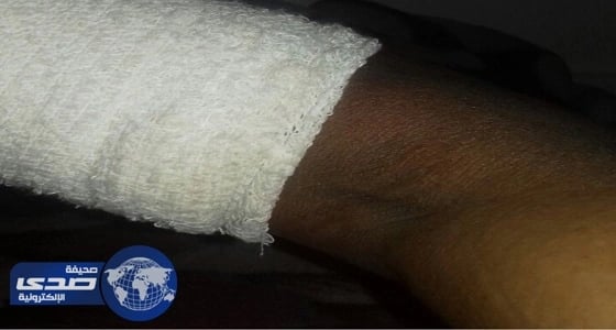 انقاذ ذراع مقيم من البتر بمستشفى الحناكية