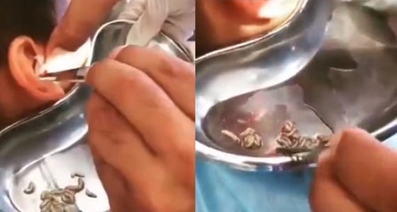 لقطات مروعة لإخراج عشرات الديدان الحية من أذن طفل