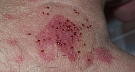 للمرة الثانية .. شكوى ضد " بريتيش أيرويز " بشأن بق الفراش