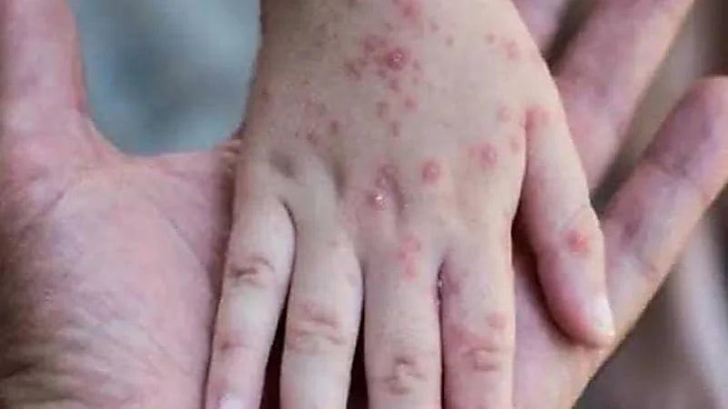 أعراض وأسباب الإصابة بجدري القرود