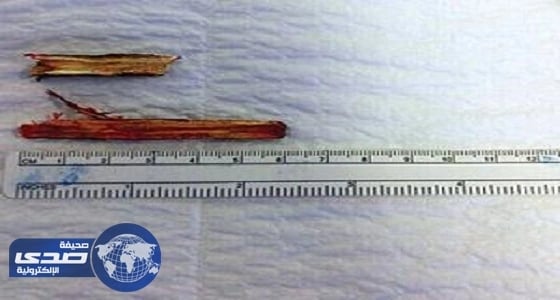 فريق طبي بمدينة الملك فهد الطبية ينقذ طفل اخترقت قطعتي خشب جمجته