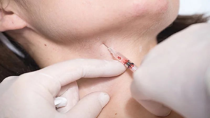 مخاطر عملية شد الجلد المترهل على الرقبة