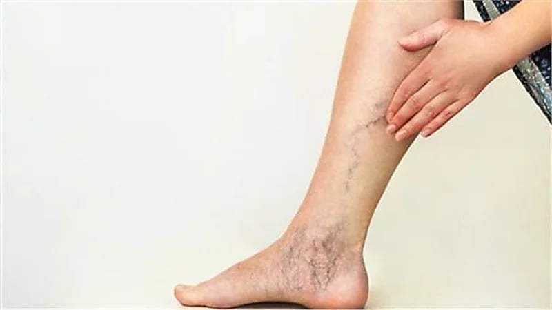 أسباب انسداد شرايين الساق وطرق علاجها