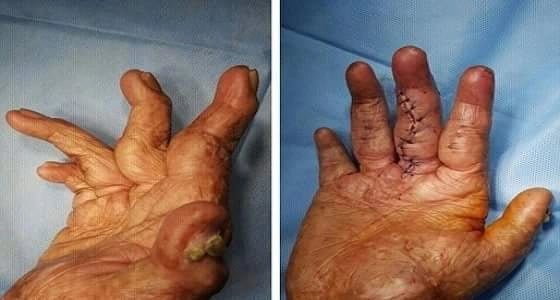 إنهاء معاناة شاب عشريني بإعادة أصابعه لطبيعتها بمستشفى دومة الجندل