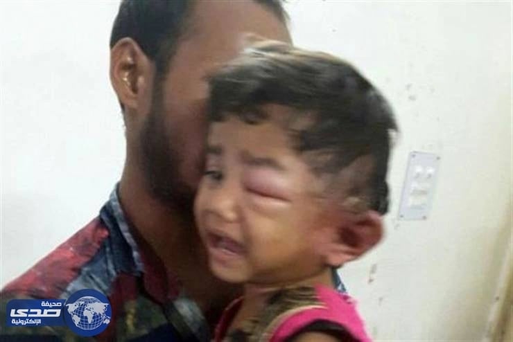 بالصور.. استخراج 80 دودة من أٌذن طفلة