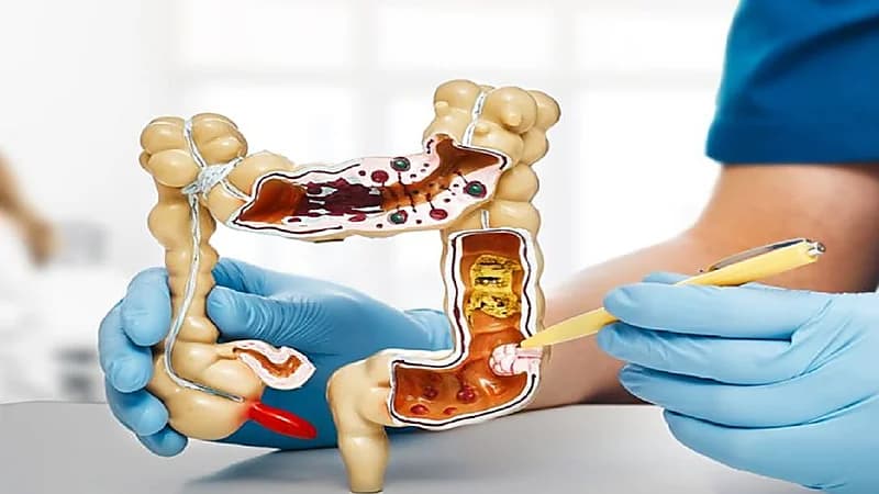 5 علامات تشير للإصابة بسرطان القولون .. فيديو