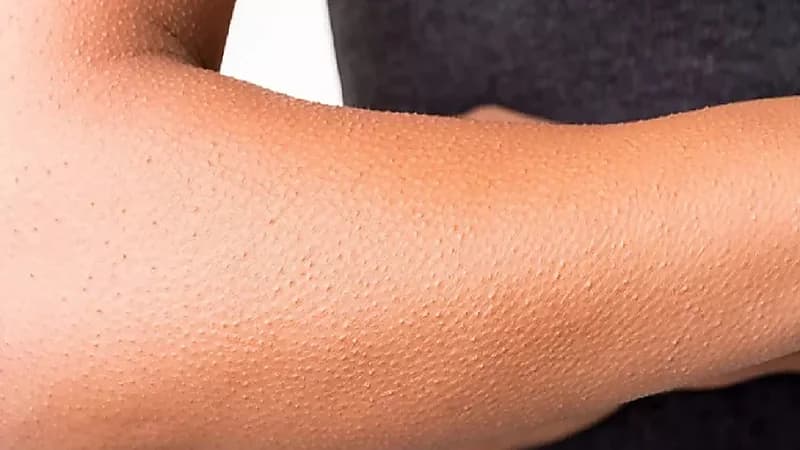 استشاري: النساء والأطفال أكثر عرضة للإصابة بمرض جلد الدجاجة.. فيديو