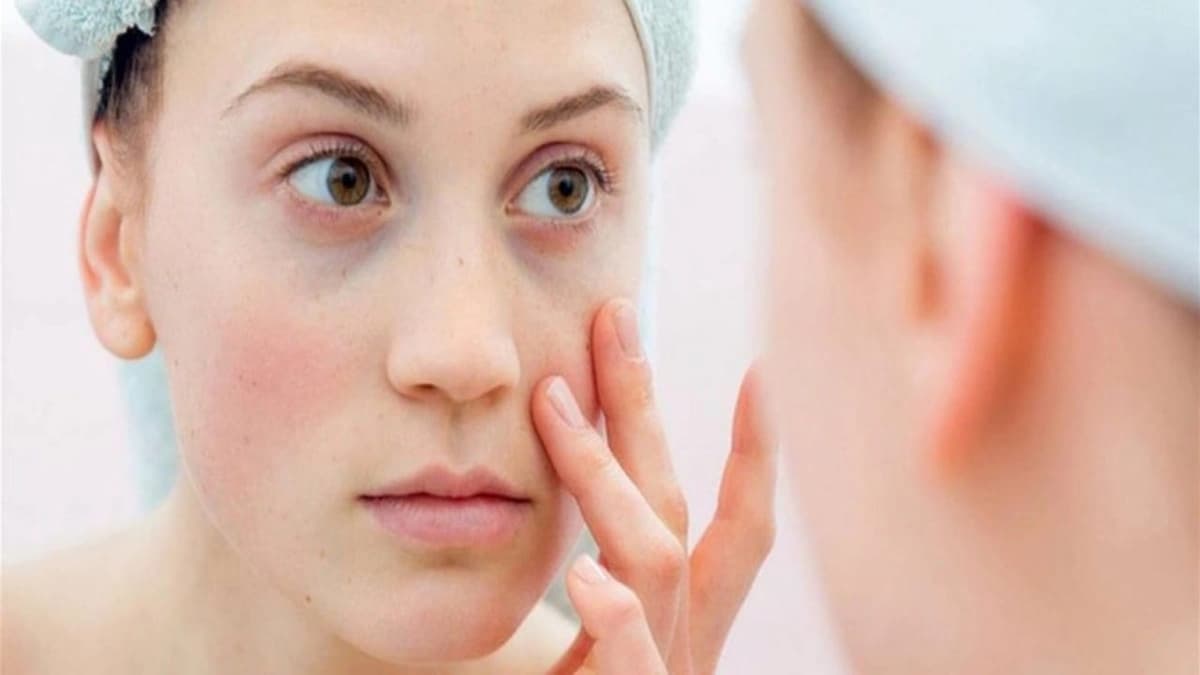 الأعراض المبكرة للذئبة الحمراء التي تصيب النساء أكثر من الرجال