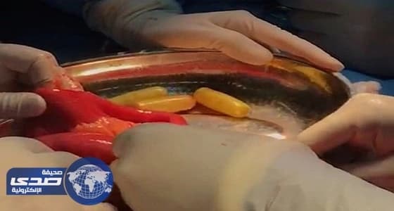 آسيوي يحاول تهريب 40 كبسولة «هيروين» داخل أحشائه في مطار جدة