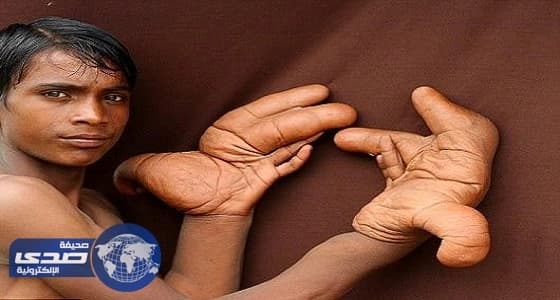 بالصور.. حالة مرضية نادرة تحول الصبي إلي " الشيطان "