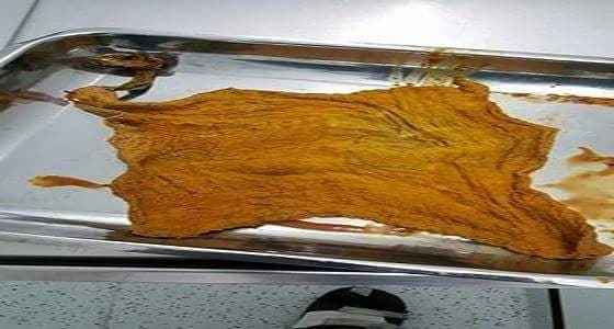 بالفيديو والصور..استخراج قطعة شاش من بطن مقيمة بعد4 شهور من عملية قيصرية